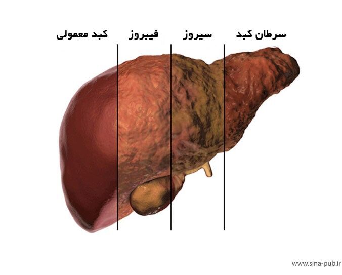 4 کبد بیمار